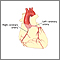 Coronary artery balloon angioplasty - series