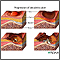 Progression of a decubitis ulcer