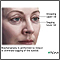 Blepharoplasty - series