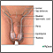 Testicular torsion repair - series