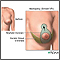 Breast lift (mastopexy) - series