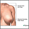 Breast reduction (mammoplasty) - series