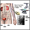 Intravenous pyelogram (IVP)