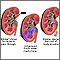 Lithotripsy procedure