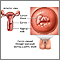 Cervical cancer