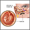 Middle ear infection