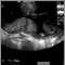 Ultrasound, normal placenta - Braxton Hicks