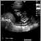 Ultrasound, normal fetus - face