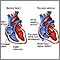 Tricuspid atresia