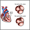 Bicuspid aortic valve