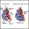 Double outlet right ventricle