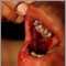 Pemphigus, vulgaris - lesions in the mouth