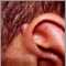 Keloid above the ear