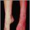 Sturge-Weber syndrome - legs