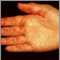 Vasculitis on the palm