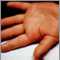 Kawasaki's disease - edema of the hand