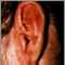 Tinea corporis - ear