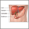 Gallbladder removal - series