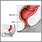 Hemorrhoid surgery  - series