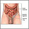 Inguinal hernia repair  - series