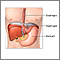 Hiatal hernia repair  - series