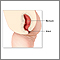 Imperforate anus repair - series