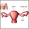 Tubal ligation  - series