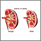 Changes in kidney with age