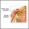 Damaged axillary nerve