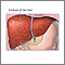 Cirrhosis of the liver