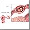 Ectopic pregnancy