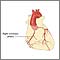 Coronary artery disease