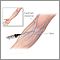 Intravenous pyelogram