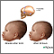 Newborn head molding