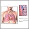 Pulmonary embolus