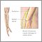 Radial nerve dysfunction