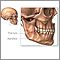 Mandibular fracture