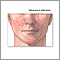 Sebaceous adenoma