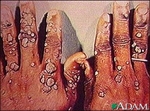 Warts, multiple - on hands