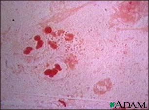 Haemophilus influenza organism