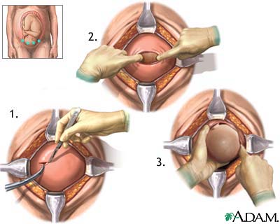 Cesarean section