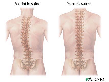 Scoliosis