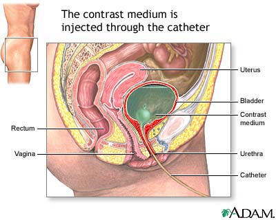 Voiding cystourethrogram