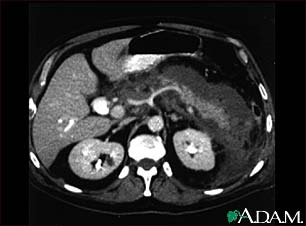 Pancreatitis, acute - CT scan