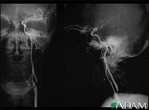 Carotid stenosis, X-ray of the left artery