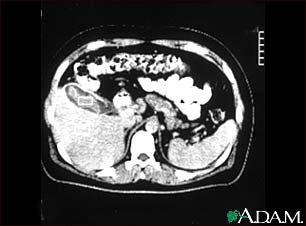 Cholecystitis, CT scan