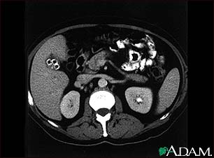 Cholecystolithiasis