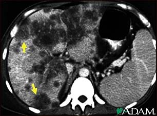 Hepatocellular cancer, CT scan