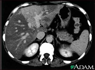 Liver with disproportional fattening, CT scan