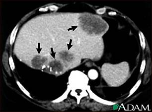 Liver metastases, CT scan